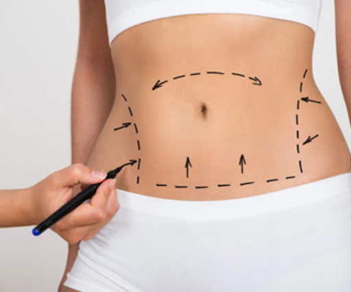 Abdominoplasty and mini abdominoplasty