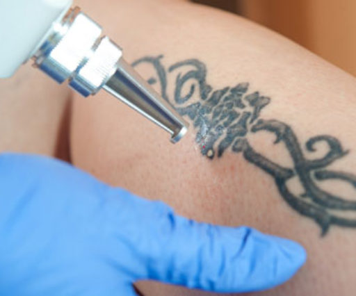 Laser tattoo removal