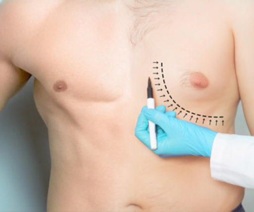 Gynecomastia