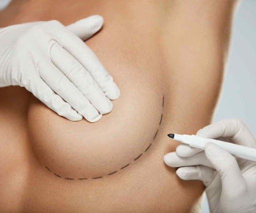 Breast lift