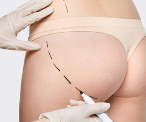 Fat transfer to the buttocks and hips