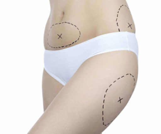 Liposuction