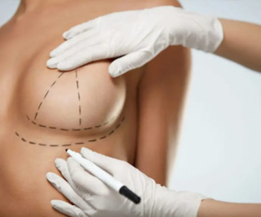 Breast reduction