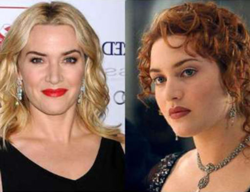 Résultats sur cinq ans pour les bénéficiaires d’une greffe du visage